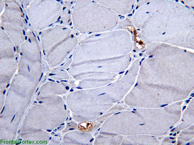 Inclusion body myositis, SMI-31 immunohistochemical stain x 400